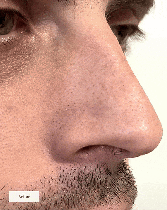 Hydrochloride Blackheads Removing Nose Patches