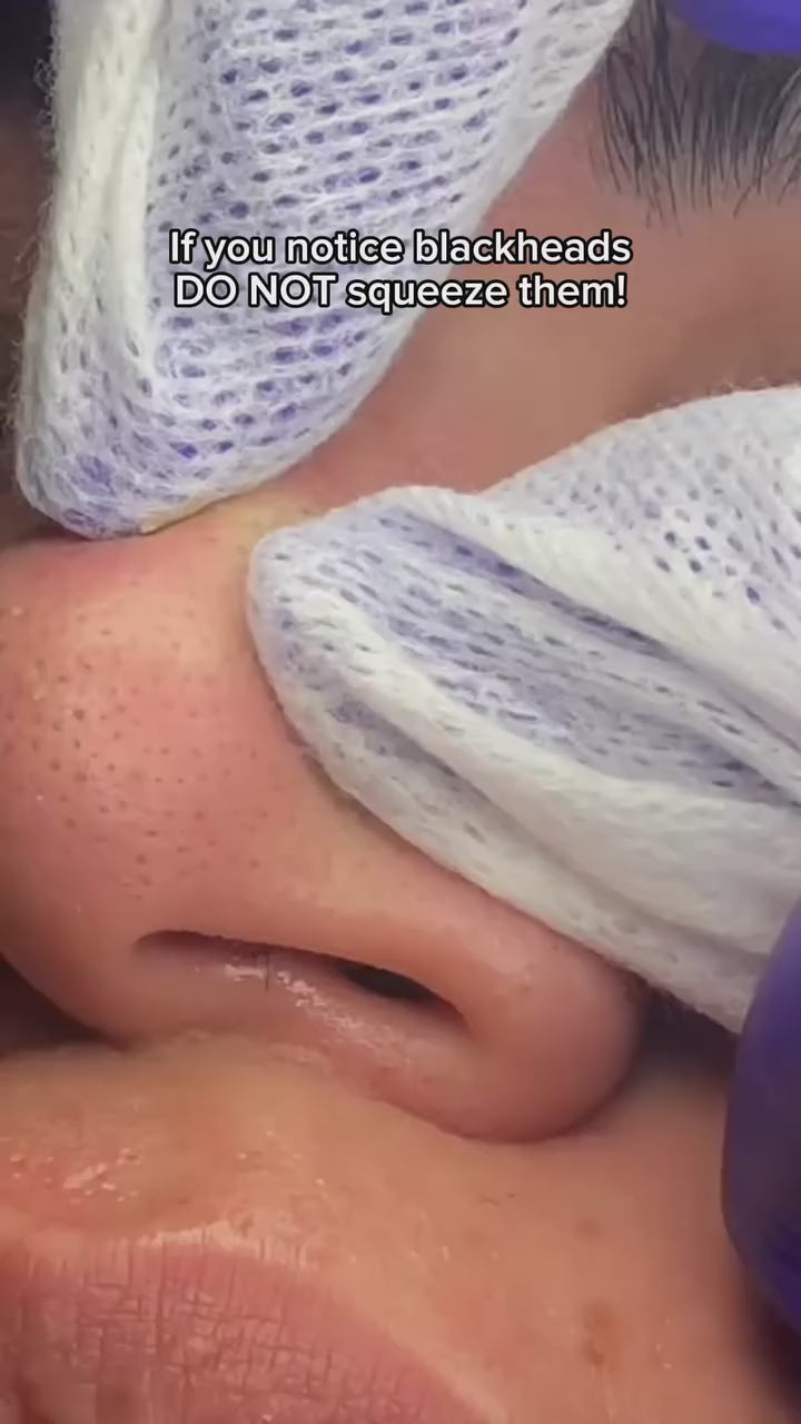 Hydrochloride Blackheads Removing Nose Patches